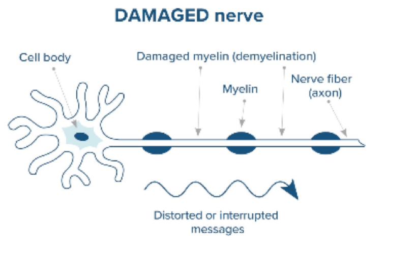 Healthy and damaged nerves